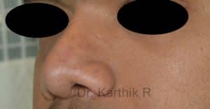 Rhinoplasty (Nose Corrections)