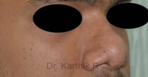 Rhinoplasty (Nose Corrections)