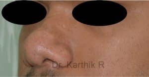 Rhinoplasty (Nose Corrections)