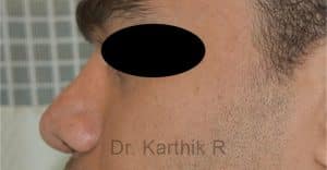 Rhinoplasty (Nose Corrections)