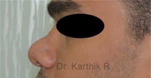 Rhinoplasty (Nose Corrections)