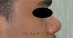 Rhinoplasty (Nose Corrections)
