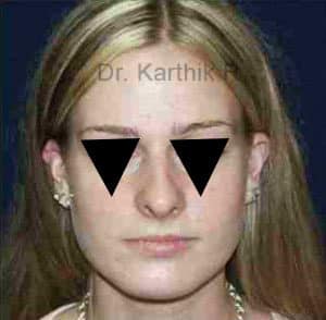 Rhinoplasty (Nose Corrections)