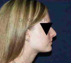 Rhinoplasty (Nose Corrections)
