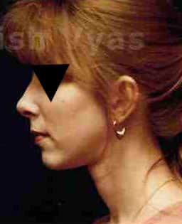 Rhinoplasty (Nose Corrections)