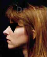 Rhinoplasty (Nose Corrections)