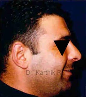 Rhinoplasty (Nose Corrections)