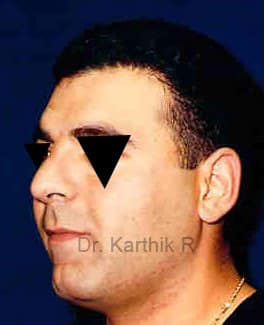 Rhinoplasty (Nose Corrections)