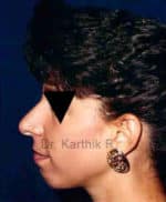 Rhinoplasty (Nose Corrections)