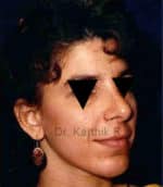 Rhinoplasty (Nose Corrections)