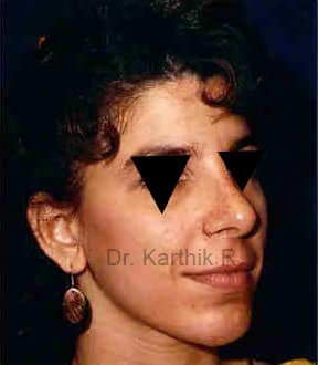 Rhinoplasty (Nose Corrections)
