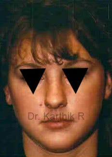 Rhinoplasty (Nose Corrections)
