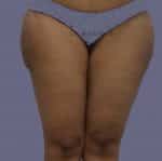 Liposuction Thighs