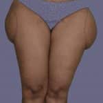 Liposuction Thighs