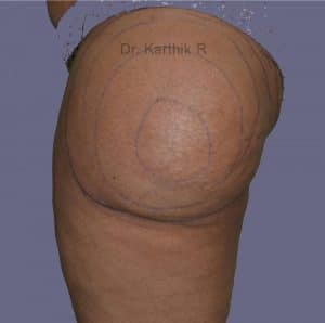 Liposuction Thighs