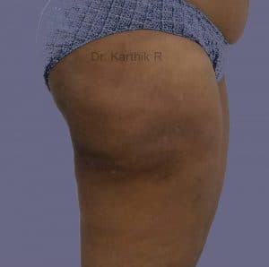 Liposuction Thighs