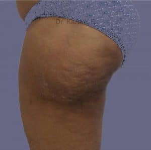 Liposuction Thighs