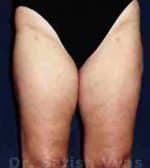 Liposuction Thighs