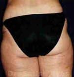 Liposuction Thighs