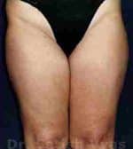 Liposuction Thighs