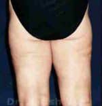 Liposuction Thighs