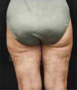 Liposuction Thighs