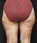 Liposuction Thighs