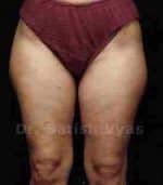 Liposuction Thighs