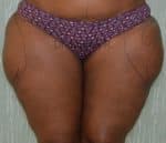 Liposuction Thighs