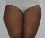 Liposuction Thighs