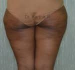 Liposuction Thighs