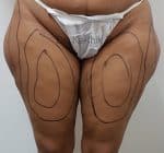 Liposuction Thighs