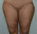 Liposuction Thighs