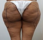 Liposuction Thighs