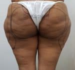 Liposuction Thighs