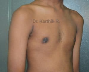 Gynecomastia (Puffy Nipples/ Male Chest Correction)