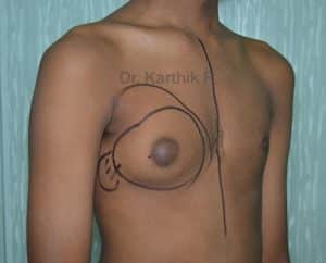 Gynecomastia (Puffy Nipples/ Male Chest Correction)