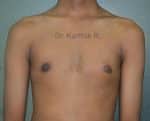 Gynecomastia (Puffy Nipples/ Male Chest Correction)