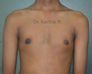 Gynecomastia (Puffy Nipples/ Male Chest Correction)