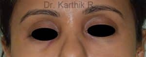 Under Eye Fat Fill