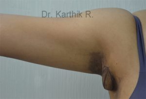 Axillary Tail of Breast