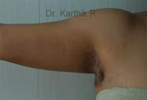 Axillary Tail of Breast