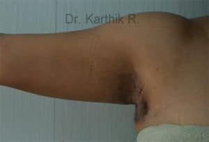 Axillary Tail of Breast