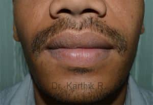 Lip Correction