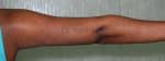 Liposuction Arms and Arm Tuck