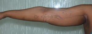 Liposuction Arms and Arm Tuck