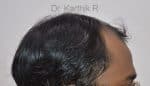 Hair Transplantation