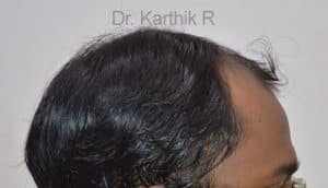 Hair Transplantation