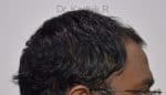 Hair Transplantation