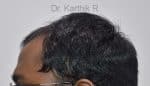 Hair Transplantation